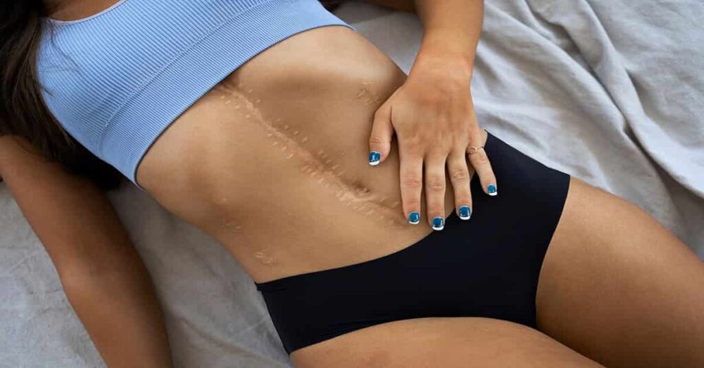 A women body shows a pragnency scar on the body